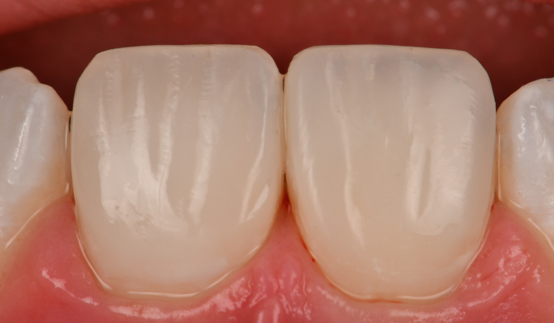 Figure 4: Final immediate post-operative result after finishing and polishing.